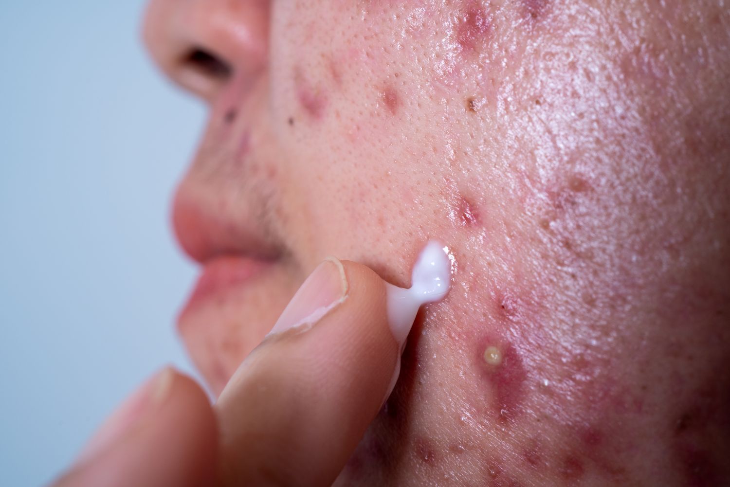Dab toothpaste on the pimple.